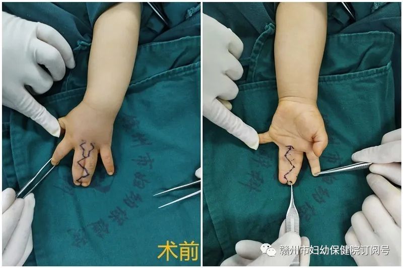 4指完全性并指患儿实施双翼皮瓣指蹼成形术,运用无需植皮的新术式治疗